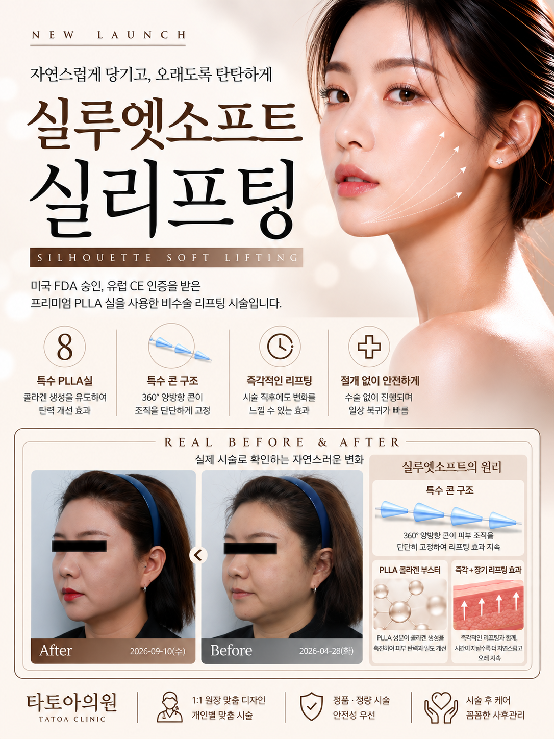 October event: Silhouette Soft thread lifting